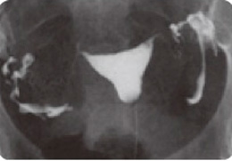 子宮卵管造影の写真